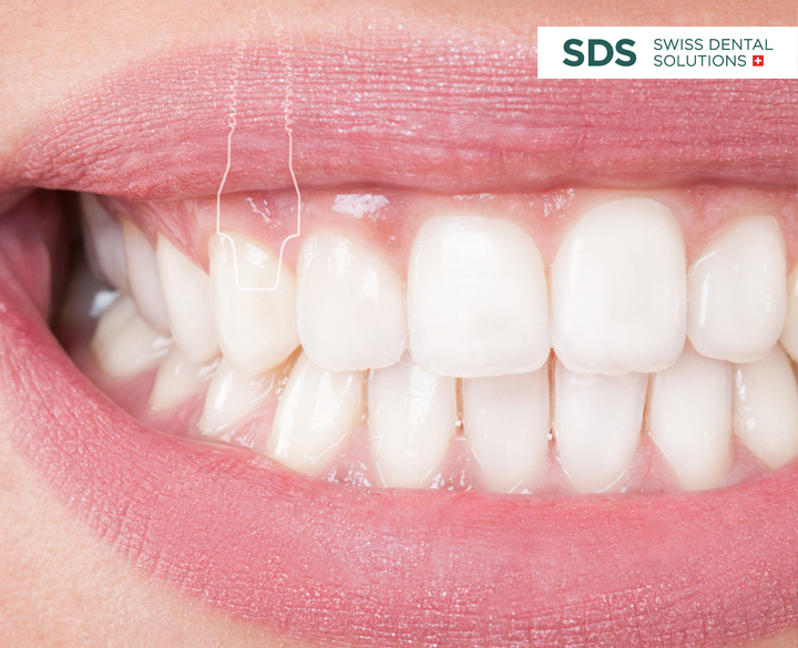 implantate01 implantate01